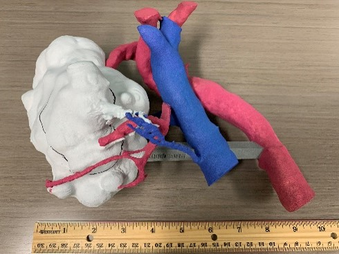 The 3D kidney and tumor model used at the Seattle Medical Center for this innovative approach