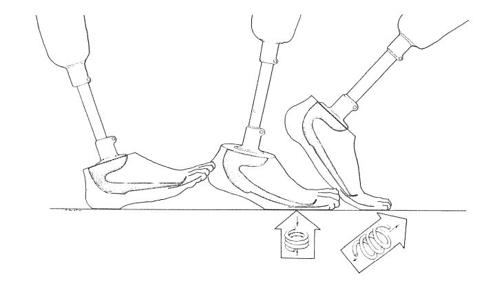 The Seattle Foot’s inner keel produces a spring-like effect, resulting in a more natural gait. (Journal of Rehabilitation Research and Development)
